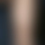 Urticaria pigmentosa. Disseminated, brownish-reddish, itchy, smooth spots and plaques on the righ...