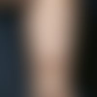 Urticaria pigmentosa. Disseminated, brownish-reddish, itchy, smooth spots and plaques on the righ...