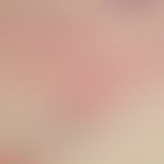Pronounced edemaof the dermis; sparse, predominantly inflammatory infiltrate in the dermis and su...