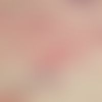 Urtikaria. Ausgeprägtes Ödem der Dermis; schütteres überwiegend entzündliches Infiltrat in Dermis...