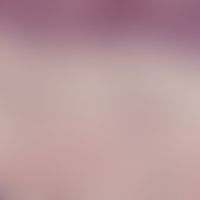 Urtikaria. Detailvergrößerung: Unverändertes Oberflächenepithel, deutliches dermales Ödem; schütt...