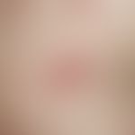 Urticaria chronic spontaneous: spontaneously developing, itchy wheals in chronic recurrent urtica...