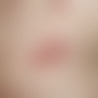 Urticaria chronic spontaneous: spontaneously developing, itchy wheals in chronic recurrent urtica...