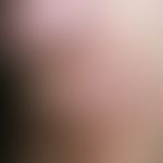 Urticaria chronic spontaneous: chronically recurrent clinical picture, confluent wheals form in a...