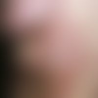 Urtikaria chronische spontane: chronisch rezidivierendes Krankheitsbild. Zu landkartenartig große...