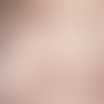 Urticaria chronic spontaneous: chronic recurrent course of urticaria with anular and gyrated patt...