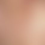 urticaria, chronic. multiple, chronically recurrent, reddish, partly confluent, volatile wheals, ...