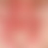 Lupus erythematosus, subacute-cutaneous. detail magnification: Multiple, solitary or confluent, s...