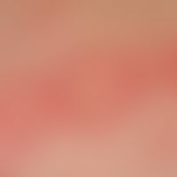 Lupus erythematodes, subakut-kutaner. Detailvergrößerung: kleinere wenig schuppige Papeln sowie g...