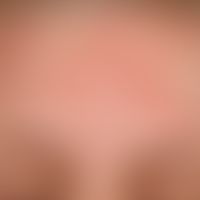 Lupus erythematosus, subacute cutaneous l upus erythematosus, detail enlargement: Multiple, small...