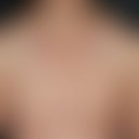 Lupus erythematosus, subacute-cutaneous, general view: Multiple, solitary and confluent, small to...