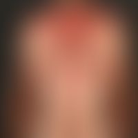 Lupus erythematodes, subakut-kutaner. Innerhalb weniger&nbsp;Monate&nbsp;sich entwickelndes, lich...