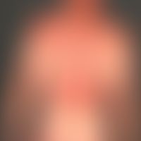 Lupus erythematosus, subacute-cutaneous. Within a few months developing, light-emphasized exanthe...