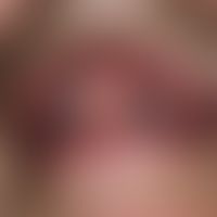 Varikose, sublinguale. Multiple, chronisch stationäre, erweiterte, teils netzartige, teils punktf...