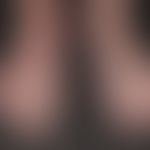 Varicose veins, extensive telangiectasia, veinctasia and reticular varices on both backs of the f...
