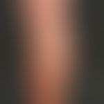 Survey image: Stemvaricosis of V. saphena magna grade IV on the right leg in a 72-year-old patien...
