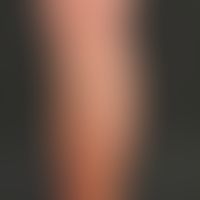 Survey image: Stemvaricosis of V. saphena magna grade IV on the right leg in a 72-year-old patien...