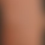 Detail enlargement: Clearly protruding V. saphena magna in grade IVvaricosis of the trunk.
