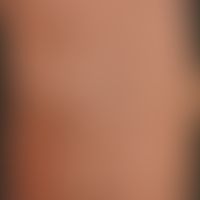 Detail enlargement: Clearly protruding V. saphena magna in grade IVvaricosis of the trunk.