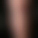 Varicose vein. extremely pronounced lateral branch varicosis on the lower leg of a 72-year-old wo...
