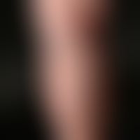 Varicose vein. extremely pronounced lateral branch varicosis on the lower leg of a 72-year-old wo...