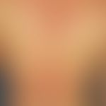 Varizellen:&nbsp;generalisiertes Exanthem mit Nebeneinander von Vesikeln, Papeln, Papulopusteln i...