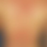 Varizellen:&nbsp;generalisiertes Exanthem mit Nebeneinander von Vesikeln, Papeln, Papulopusteln i...