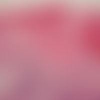 Varizellen. Intraepidermale Blasenbildung. Das Dach der Blase wird durch die orthokeratotische Ho...