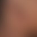 Varizellen: Detailaufnahme. Vesikulöses, juckendes Exanthem, mit disseminierten prall gespannten ...