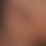 Varizellen: Detailaufnahme. Vesikulöses, juckendes Exanthem, mit disseminierten prall gespannten ...