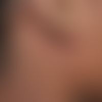 Varicella: Close-up; vesicular, itchy exanthema with disseminated, tense and taut vesicles.
