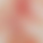 Vaskulitis, leukozytoklastische (non-IgA-assoziierte). Auflichtmikroskopie: Frische und ältere Ei...