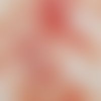 Vaskulitis, leukozytoklastische (non-IgA-assoziierte). Auflichtmikroskopie: Frische und ältere Ei...
