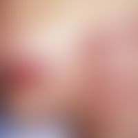 Verbrennung. Streifenförmige Verbrennungen 2. Grades durch Elektrozaunkontakt bei einem 8-jährige...