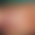 Point-like, 3rd degree burns caused by squeezing out glowing cigarette ends on the back of the ha...