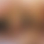 Burns: severe fourth-degree burns on the buttocks of a 23-year-old woman after gynaecological sur...
