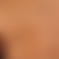 Verruca seborrhoica: Multiple, brown-black, attached papules, plaques and nodes in the area of th...