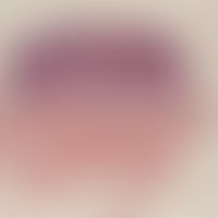 Verruca seborrhoica. acanthotic type. broad-based, exophytic tumor, no infiltrating growth; appea...