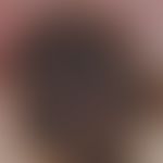 Verruca seborrhoica. reflected light microscopy: Exophytically growing verruca seborrhoica manife...