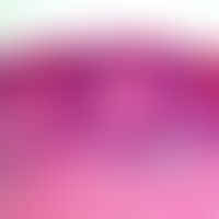 Verruca seborrhoica. clonal type (epithelioma, intraepithelial): Strong, irregular acanthosis and...