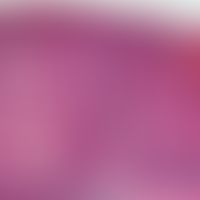 Verruca seborrhoica. clonal type (epithelioma, intraepithelial): Detail of the above figure: Shar...