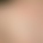 Verruca seborrhoica: General view: For many years a 7 x 5 mm large, brown-black tumor on the left...