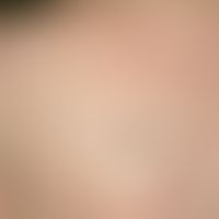 Verruca seborrhoica: General view: For many years a 7 x 5 mm large, brown-black tumor on the left...