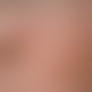 Verruca seborrhoica: General view: On the left side of the picture a 10 x 7 mm large, brown-black...