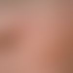 Verruca seborrhoica: General view: On the left side of the picture a 10 x 7 mm large, brown-black...