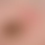 Verruca seborrhoica. detail magnification: 10 x 7 mm, non-itching, greyish-brown, broad-based pla...