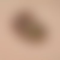 Verruca seborrhoica, approx. 8 x 5 mm in size, raised, grey-brown, broad plaque on the lower surf...