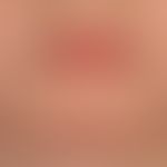 Verrucae planae juveniles. Vor einem halben Jahr erstmalig am Kinn eines 10-jährigen Jungen aufge...
