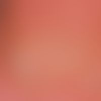 verrucae plantares. sole of the foot in a 13-year-old competitive swimmer. painfulness during wal...
