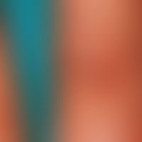 Verrucae vulgar. up to 0.6 cm in size, skin-coloured to whitish, chronic, rough papules and nodul...